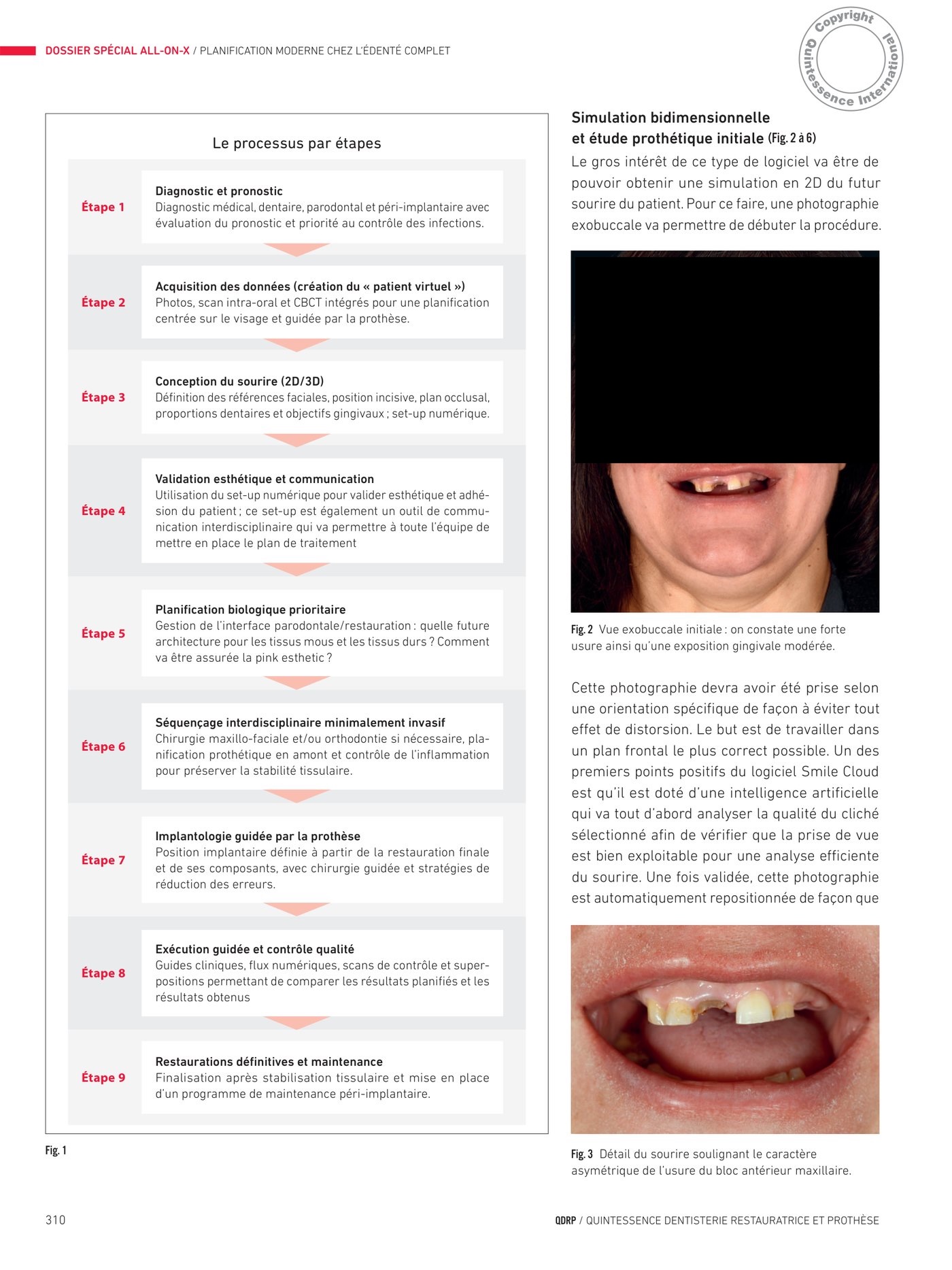 Simulation bidimensionnelle du sourire et étapes du processus par Smile Cloud