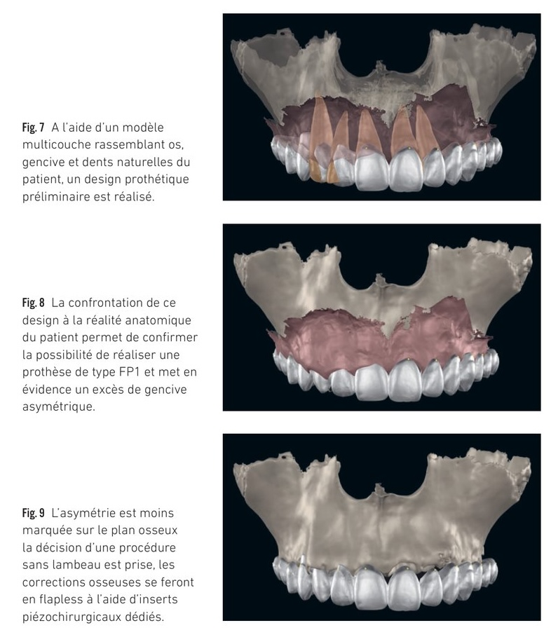 Classification de Misch FP1/FP2/FP3 — identification de l'espace occlusoprothétique disponible