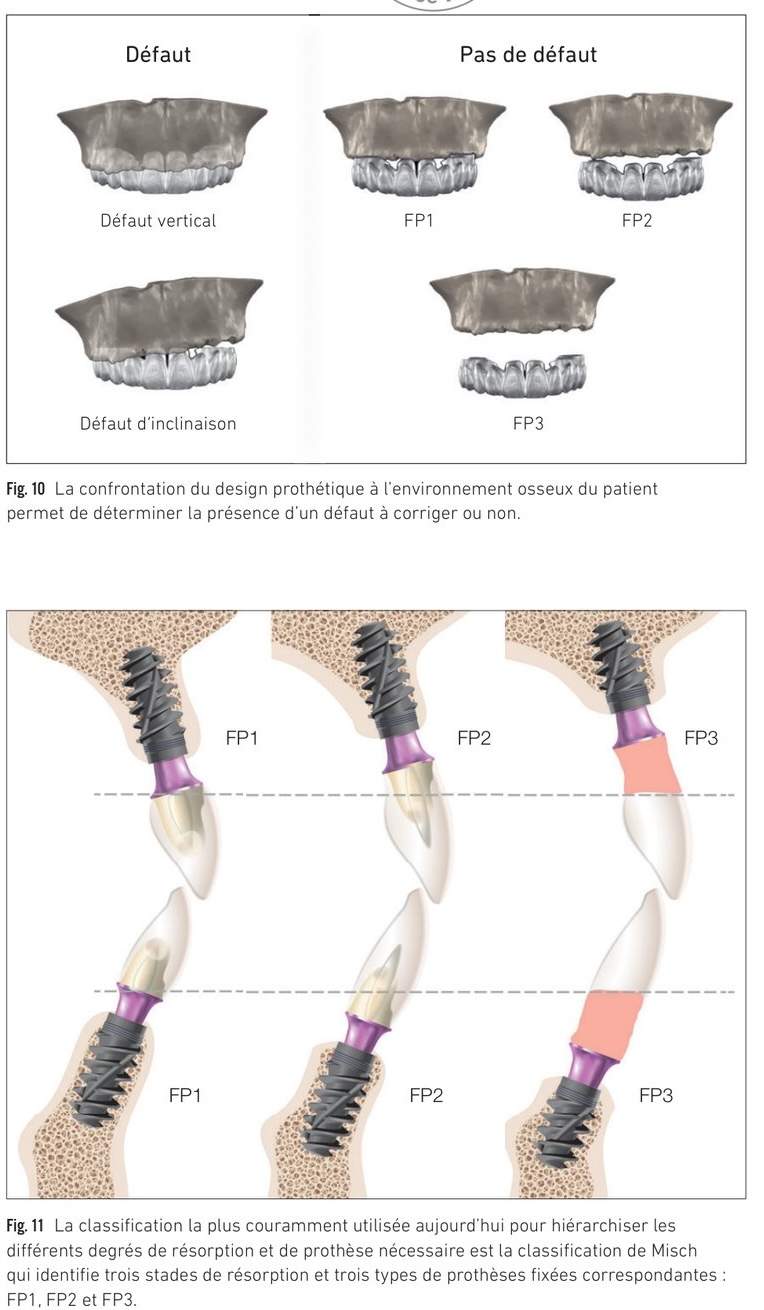 Tableau décisionnel selon la classification de Misch et les défauts présents