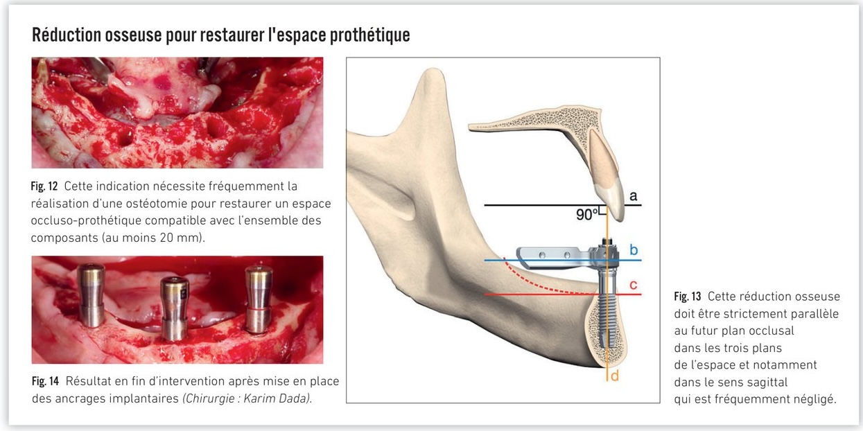 Proposition d'arbre décisionnel pour le choix du guide chirurgical — cas avec défaut osseux
