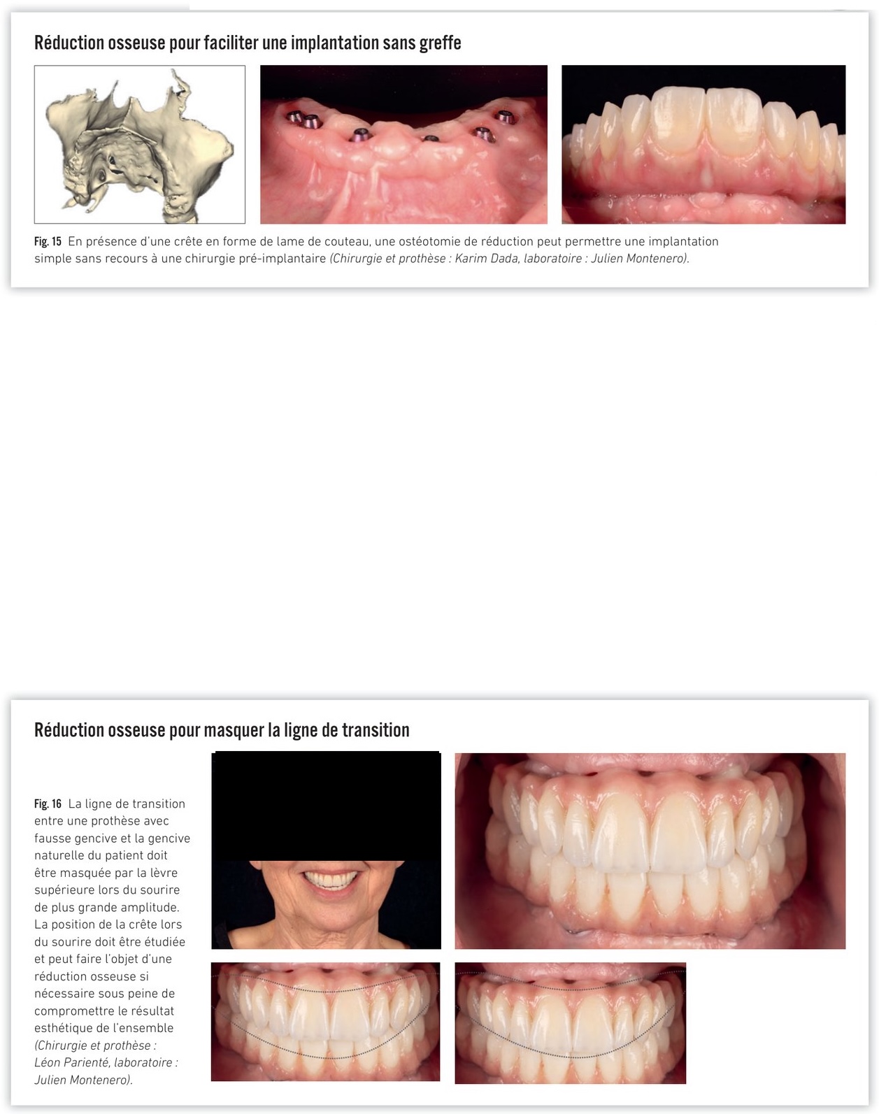 Indications de réduction osseuse — sourire gingival, défaut d'inclinaison, ligne de transition