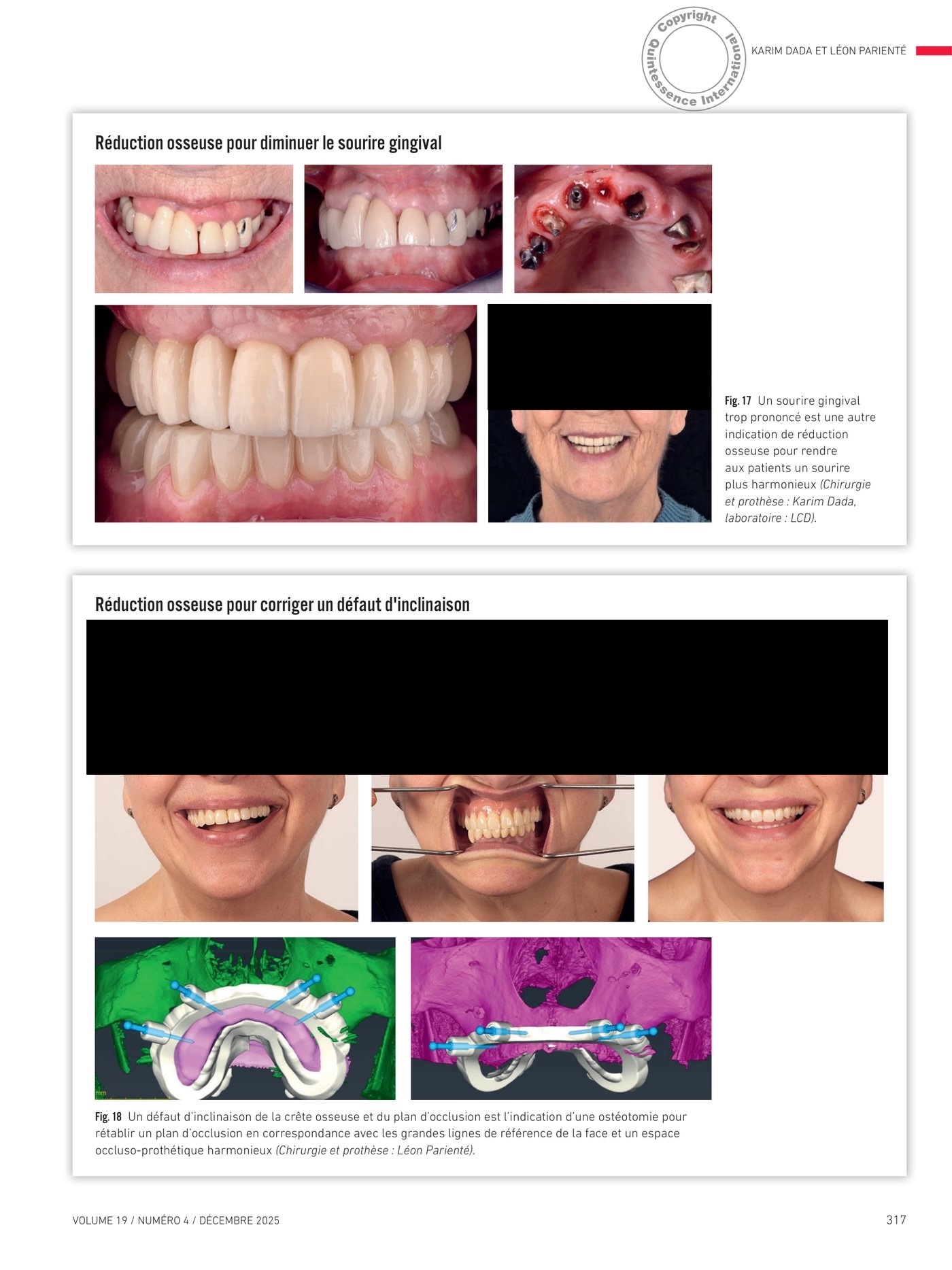 Réduction osseuse guidée pour corriger le sourire gingival et les défauts d'inclinaison
