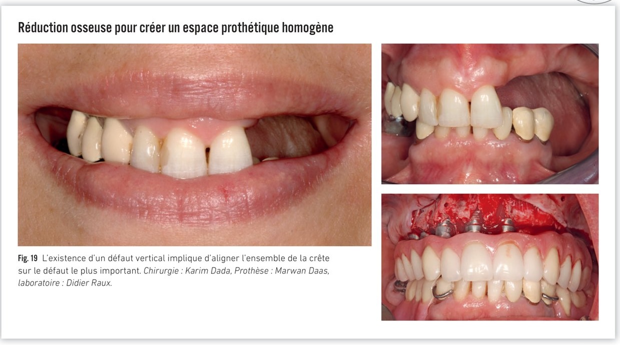 Conception et mise en place du guide à étage — tracé du guide basal et clavettes