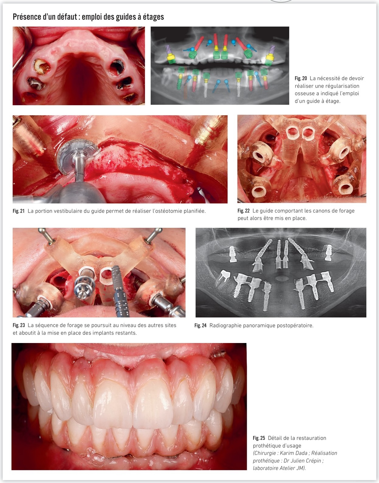 Emploi des guides à étages — ostéotomie guidée et mise en place séquentielle des implants