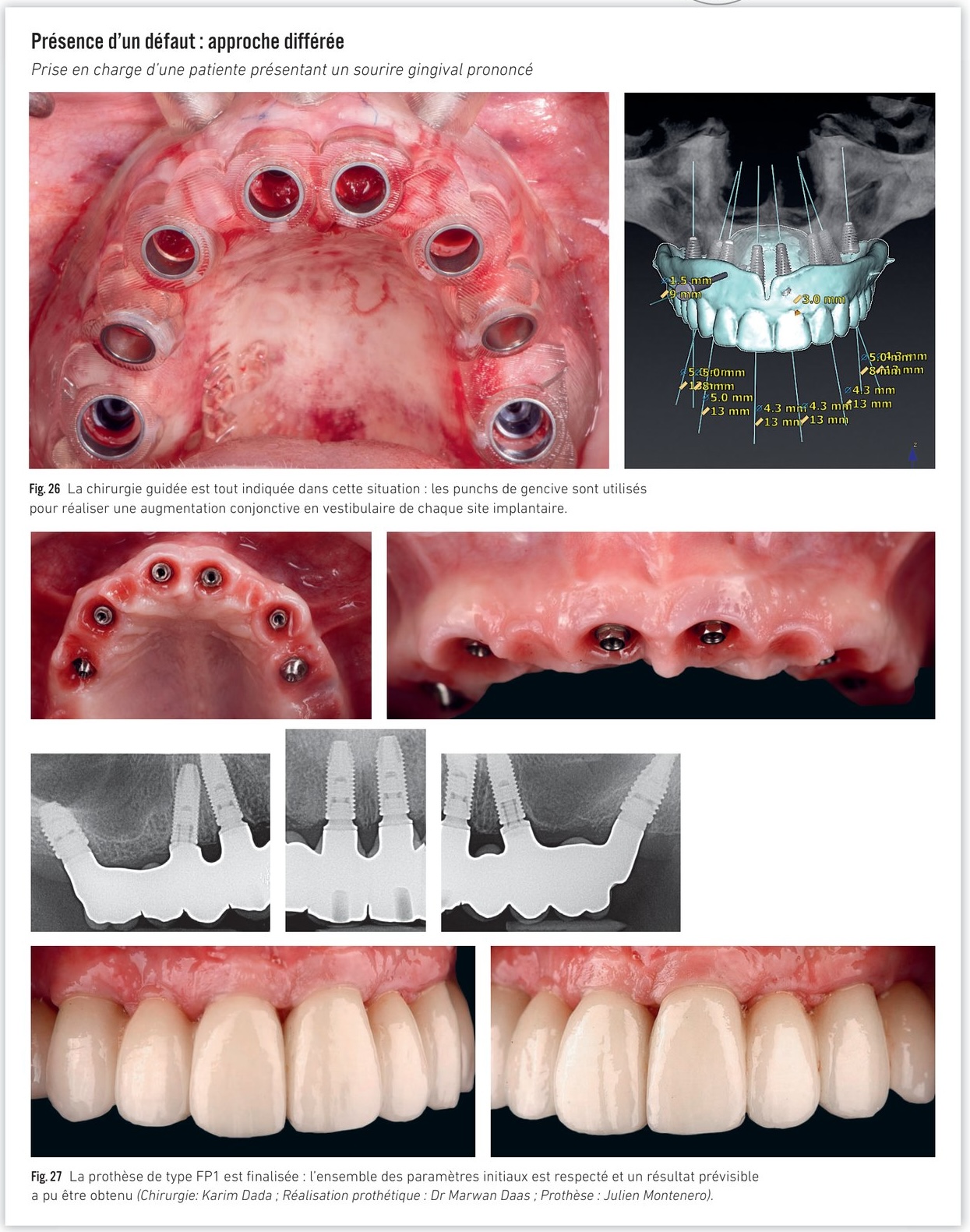 Cas clinique — patiente avec sourire gingival prononcé, chirurgie guidée et résultat FP1