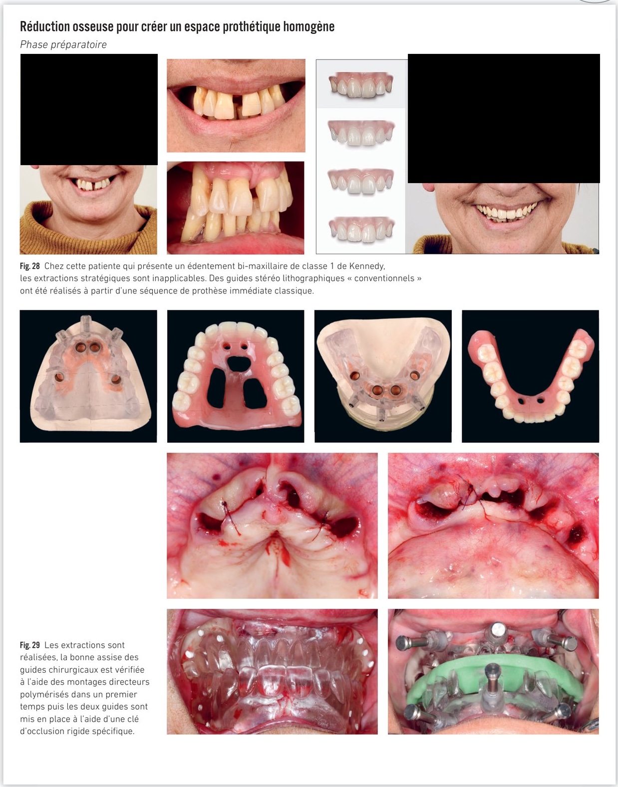 Réduction osseuse, phase préparatoire et mise en place des implants avec guides conventionnels