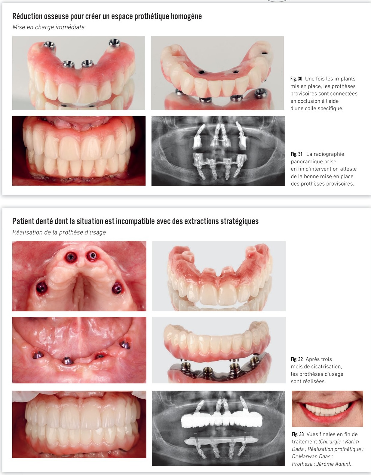 Mise en charge immédiate et réalisation de la prothèse d'usage — résultat final