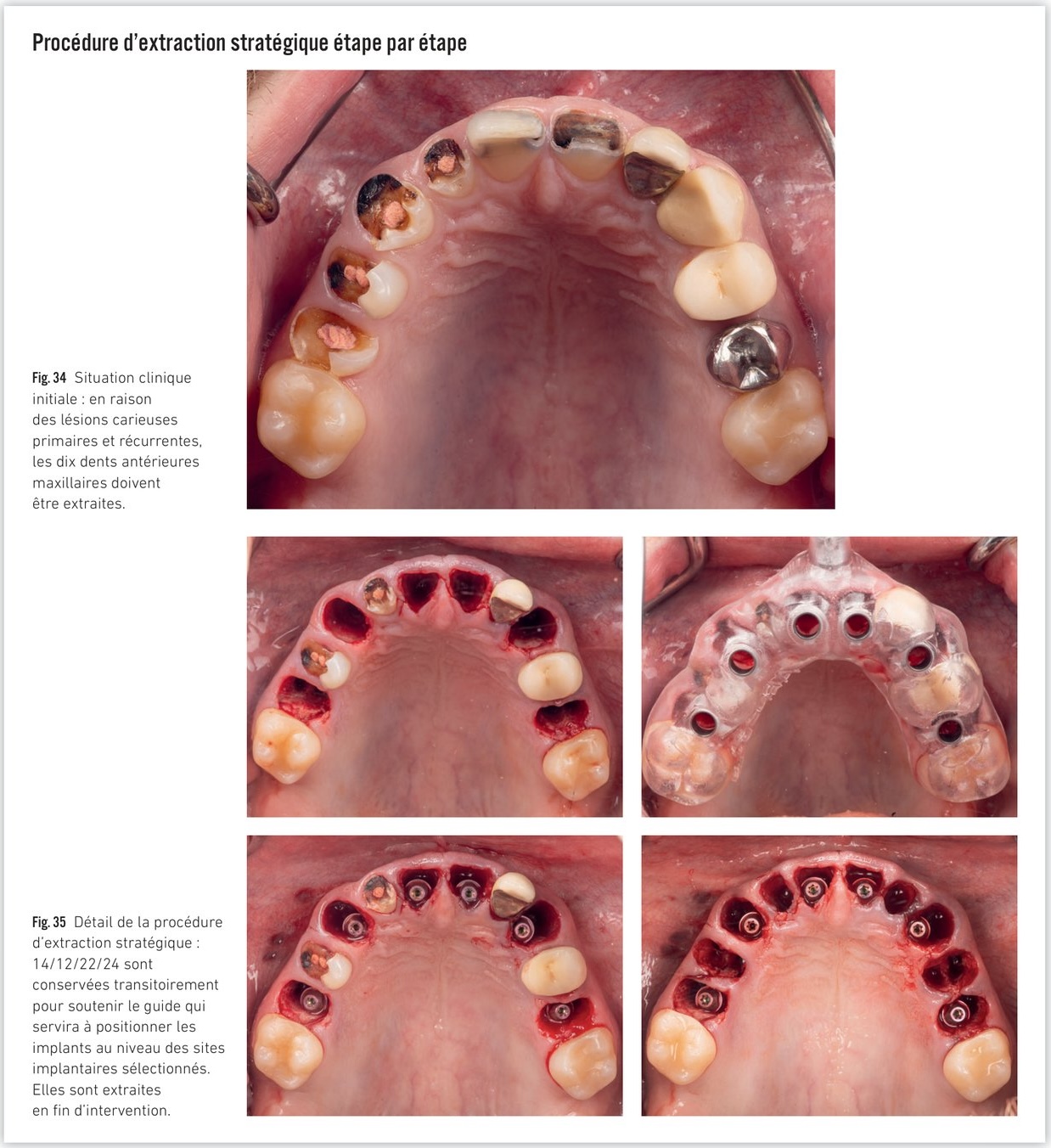 Procédure d'extraction stratégique — conservation des dents relais et guide à appui dentaire