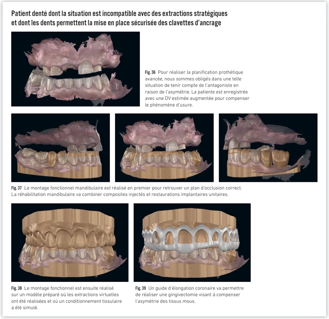 Guide avec clavettes d'ancrage — gingivectomie, mise en place des implants et bridge provisoire