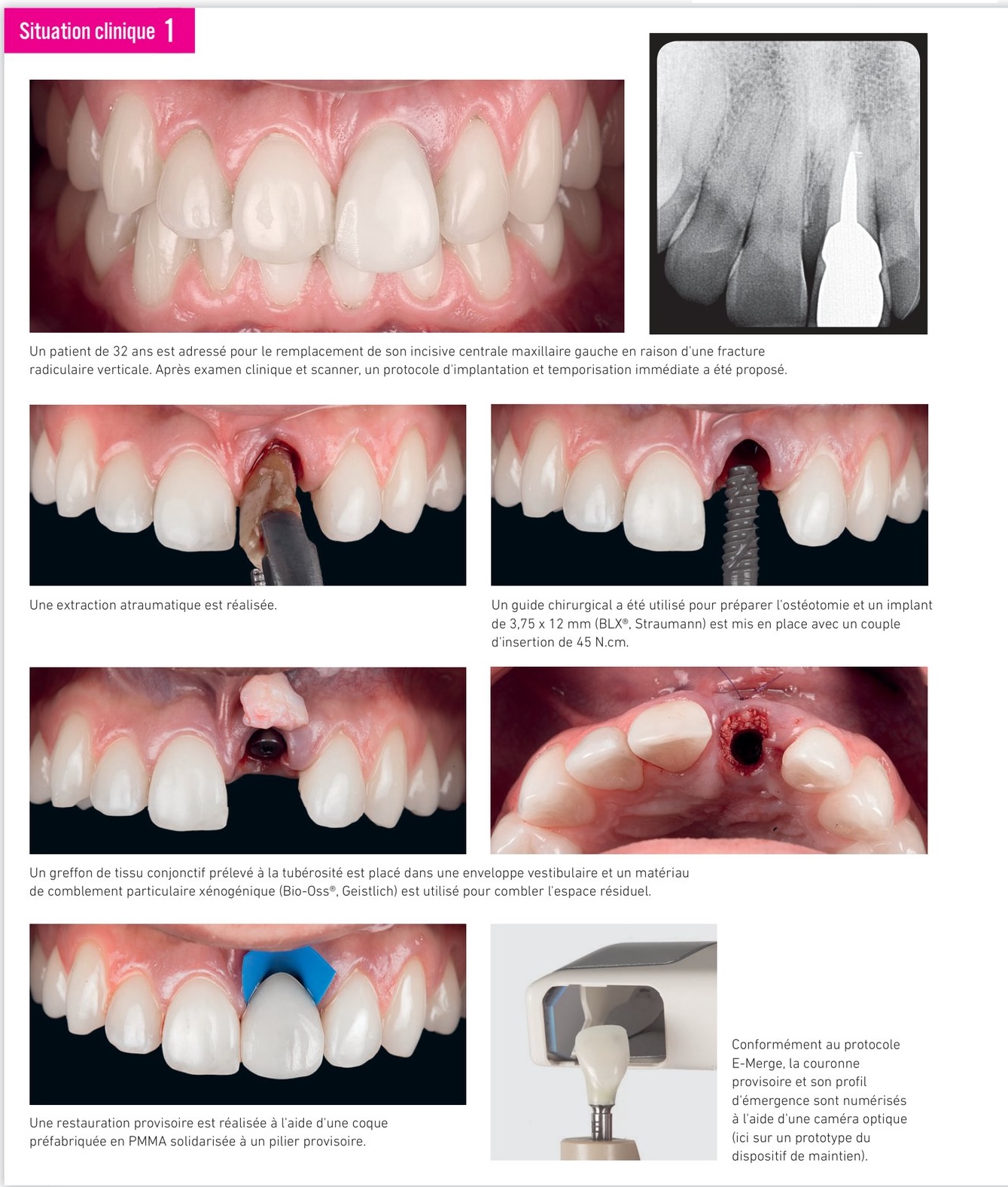 Situation clinique 1 — fusion STL, modèle imprimé et conception de la couronne définitive