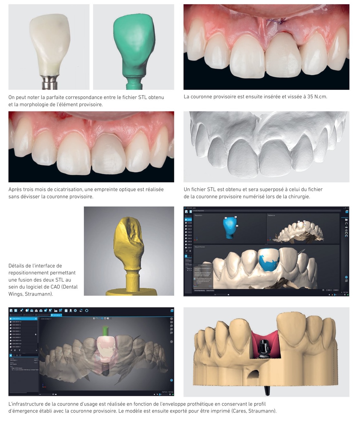 Situation clinique 1 — profil d'émergence, prothèse d'usage et résultat à 1 an