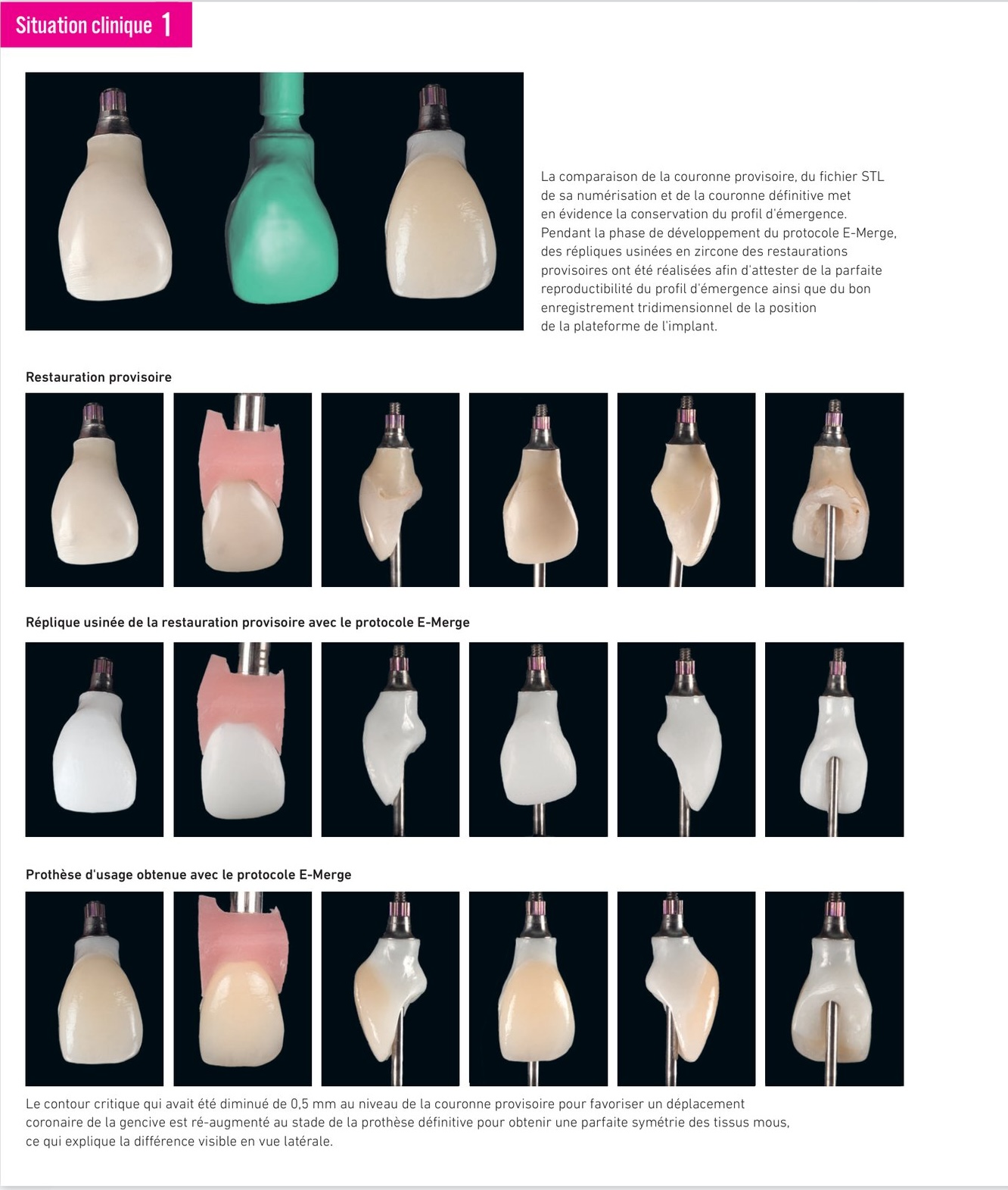 Situation clinique 1 — comparaison provisoire / STL / couronne définitive et résultat final