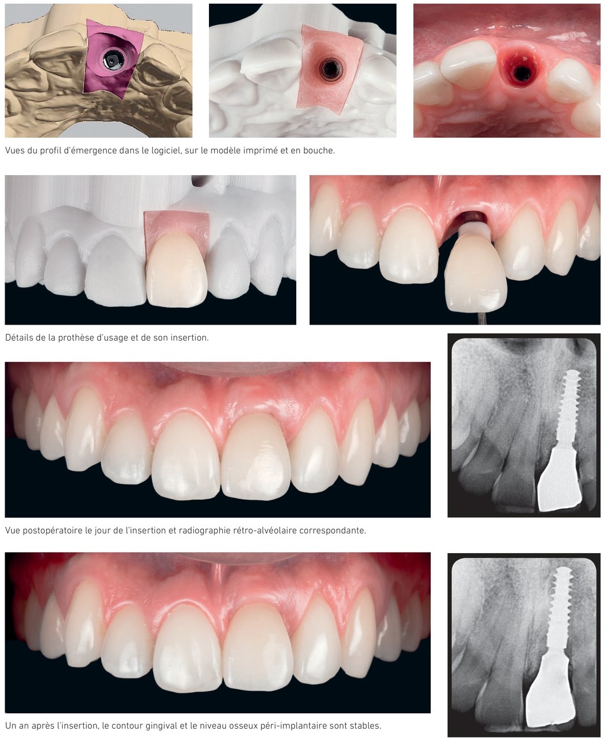 Situation clinique 1 — vue du profil d'émergence en bouche, insertion et radiographie de contrôle