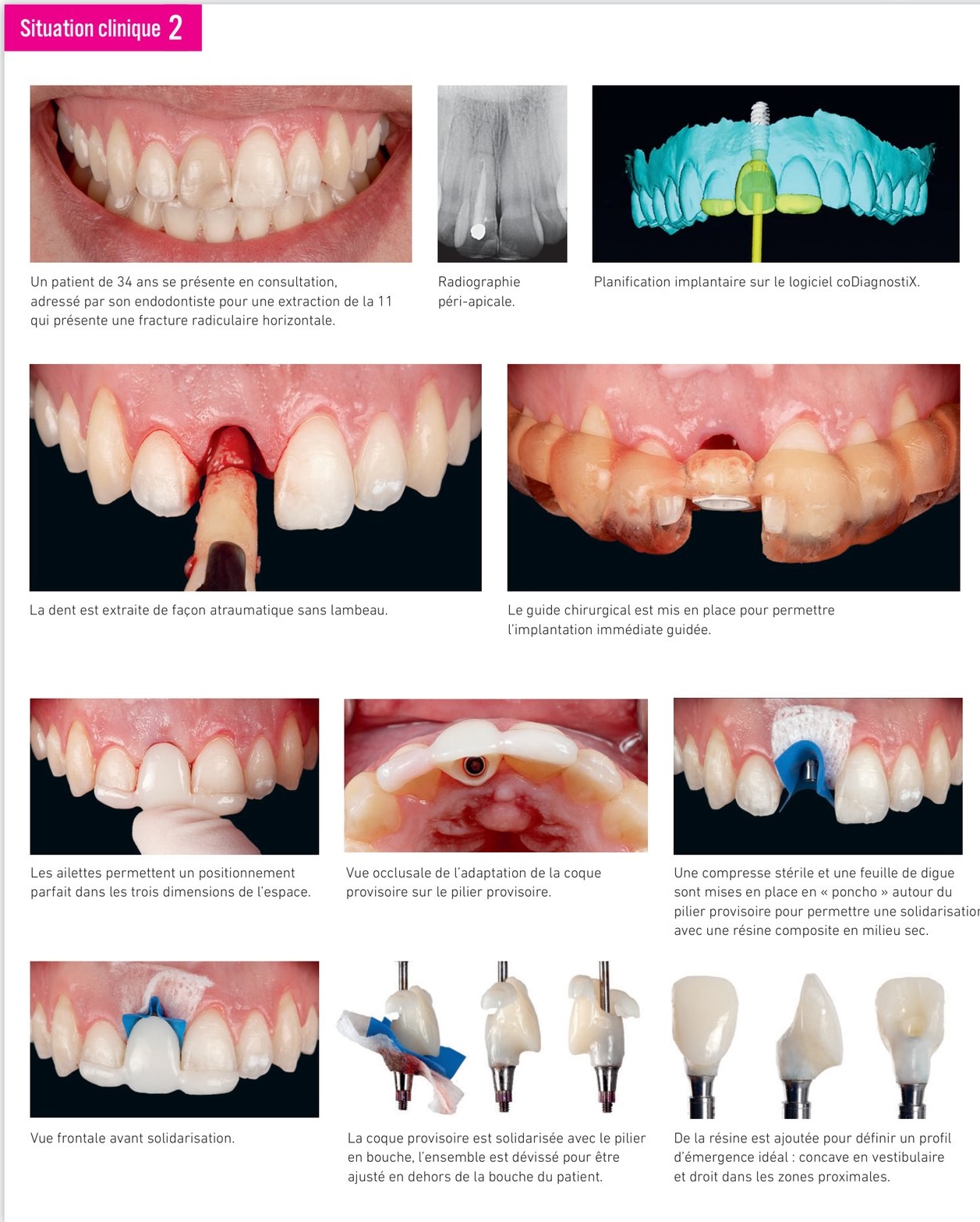 Situation clinique 2 — extraction, implantation immédiate et greffons conjonctifs