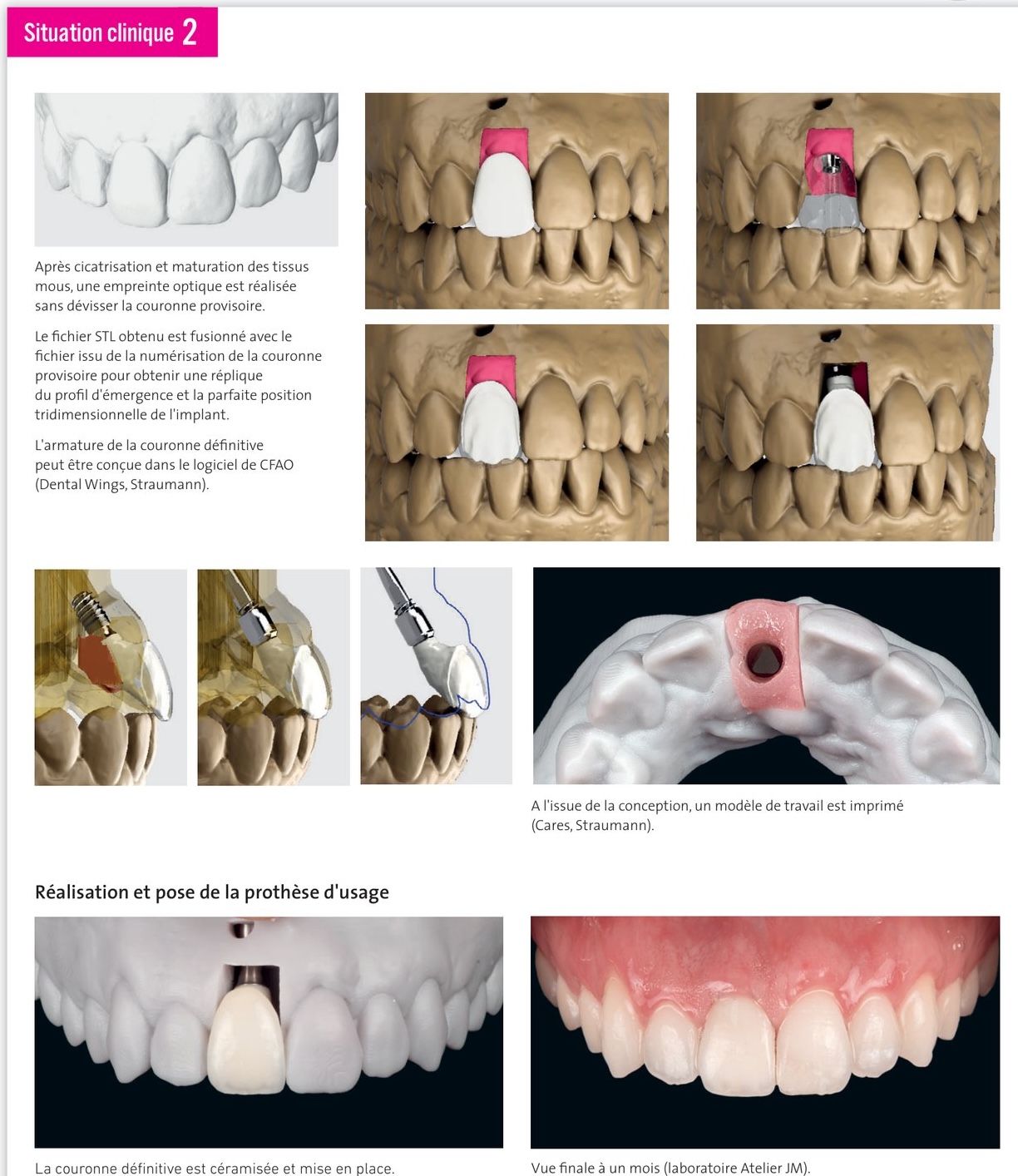Situation clinique 2 — prothèse d'usage, modèle imprimé et résultat à 1 mois