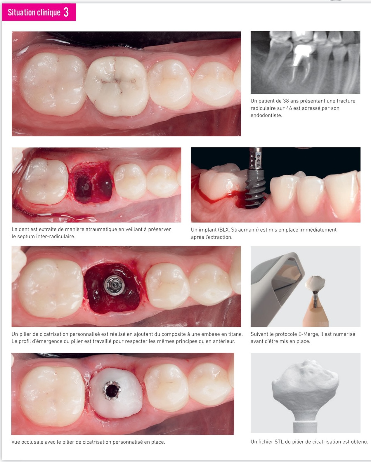 Situation clinique 3 — pilier de cicatrisation personnalisé et protocole E-Merge en zone postérieure