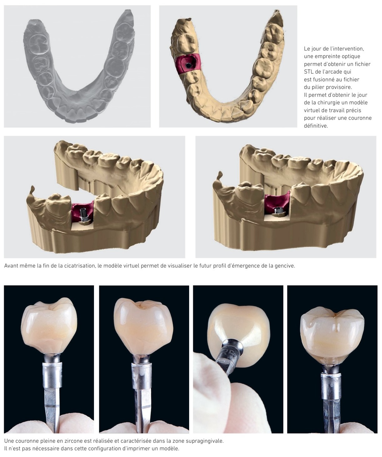 Situation clinique 3 — modèle virtuel, couronne zircone et résultat final sans modèle physique