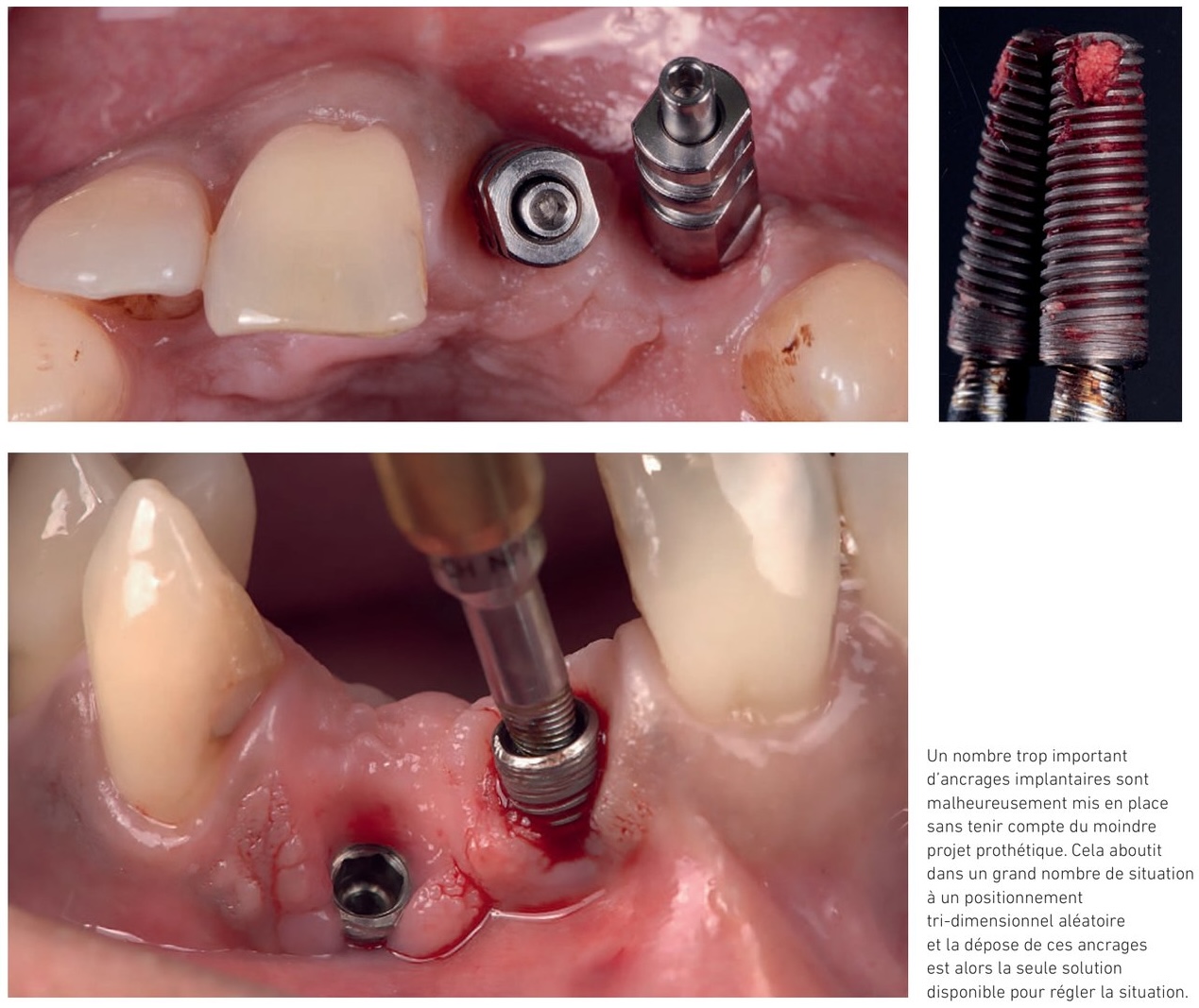Exemples de positions implantaires aberrantes incompatibles avec le projet prothétique
