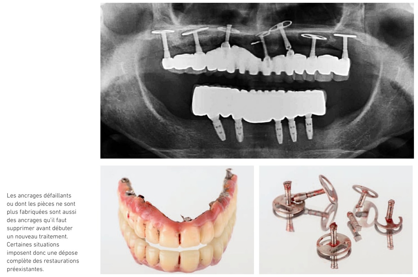 Exemples de pièces implantaires endommagées et identification par Spotimplant