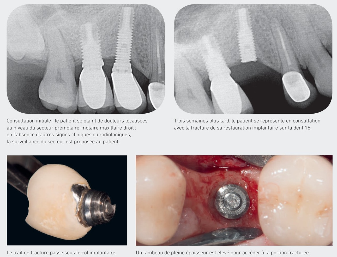 Cas clinique d'implant fracturé — situation initiale et radiographie