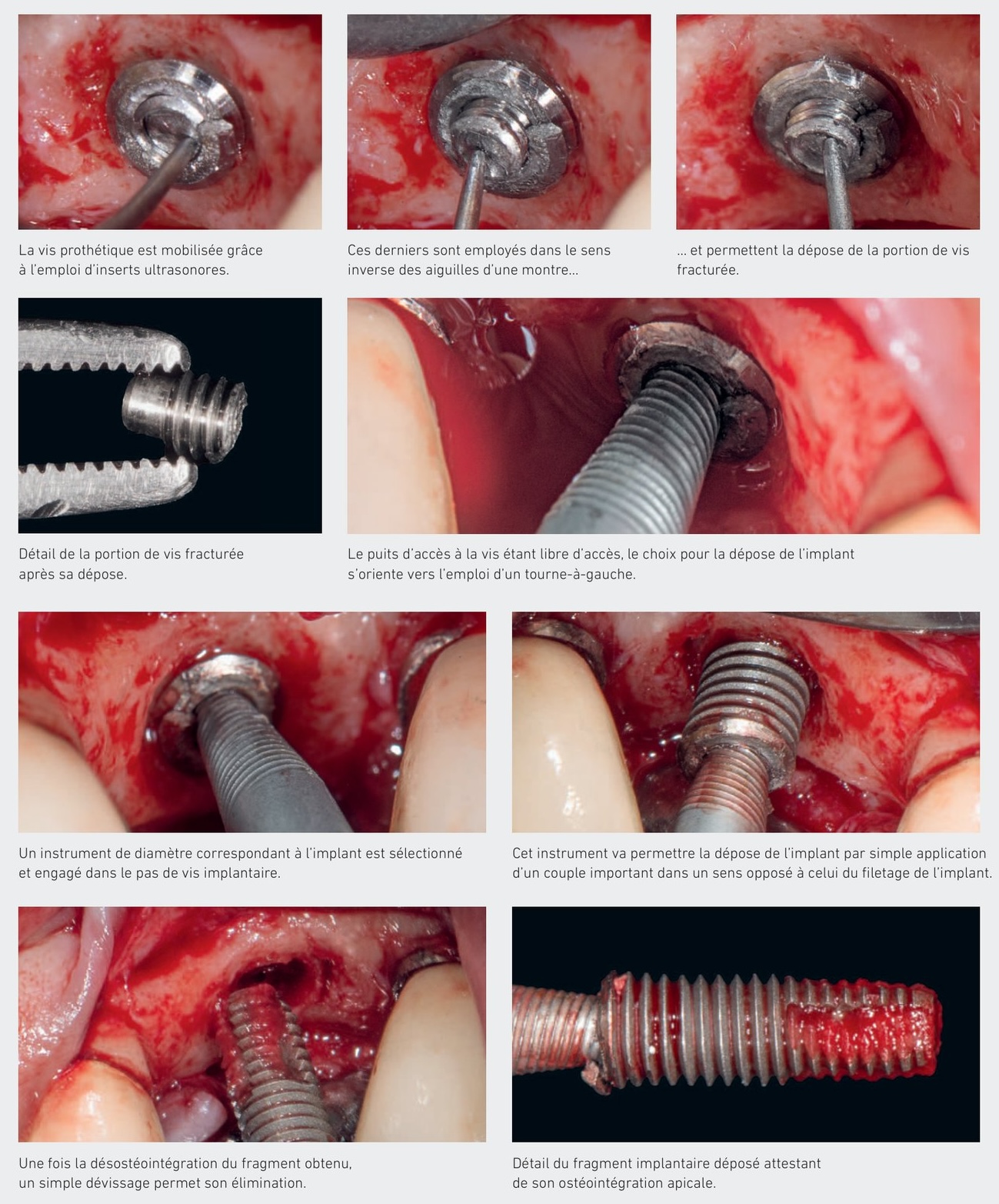 Cas clinique d'implant fracturé — étapes instrumentales de dépose
