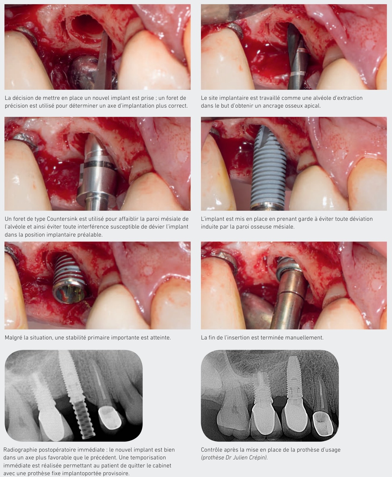 Cas clinique d'implant fracturé — mise en place du nouvel implant