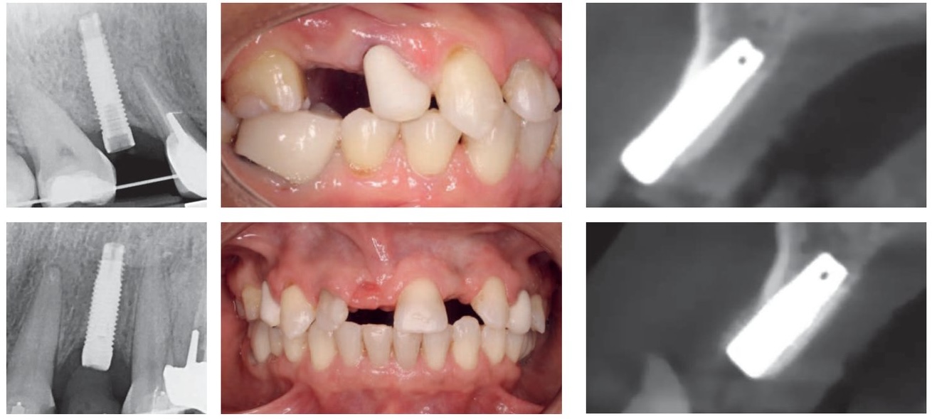 Enfouissement d'implant — situation initiale et étapes chirurgicales