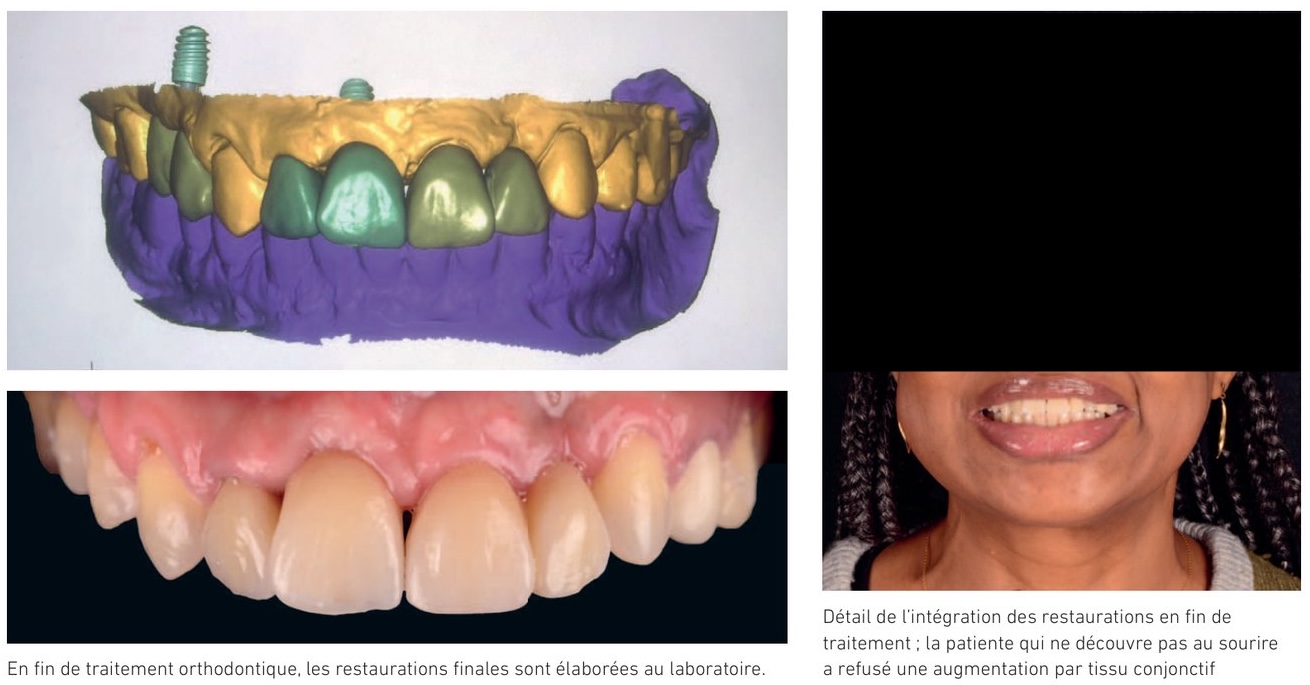 Enfouissement d'implant — restaurations finales