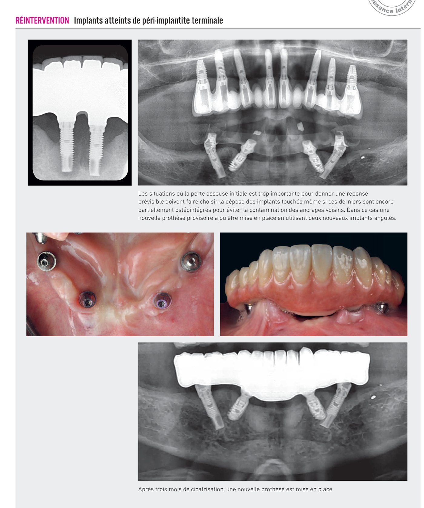 Cas clinique : péri-implantite terminale — dépose et gestion du site