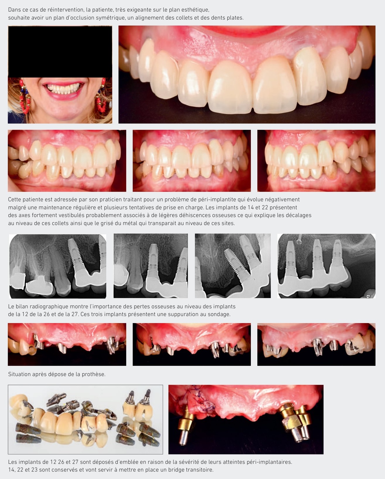 Réhabilitation globale avec péri-implantite — situation initiale