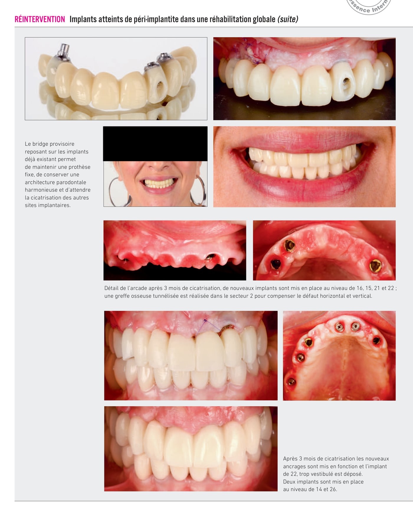 Réhabilitation globale — étapes de traitement