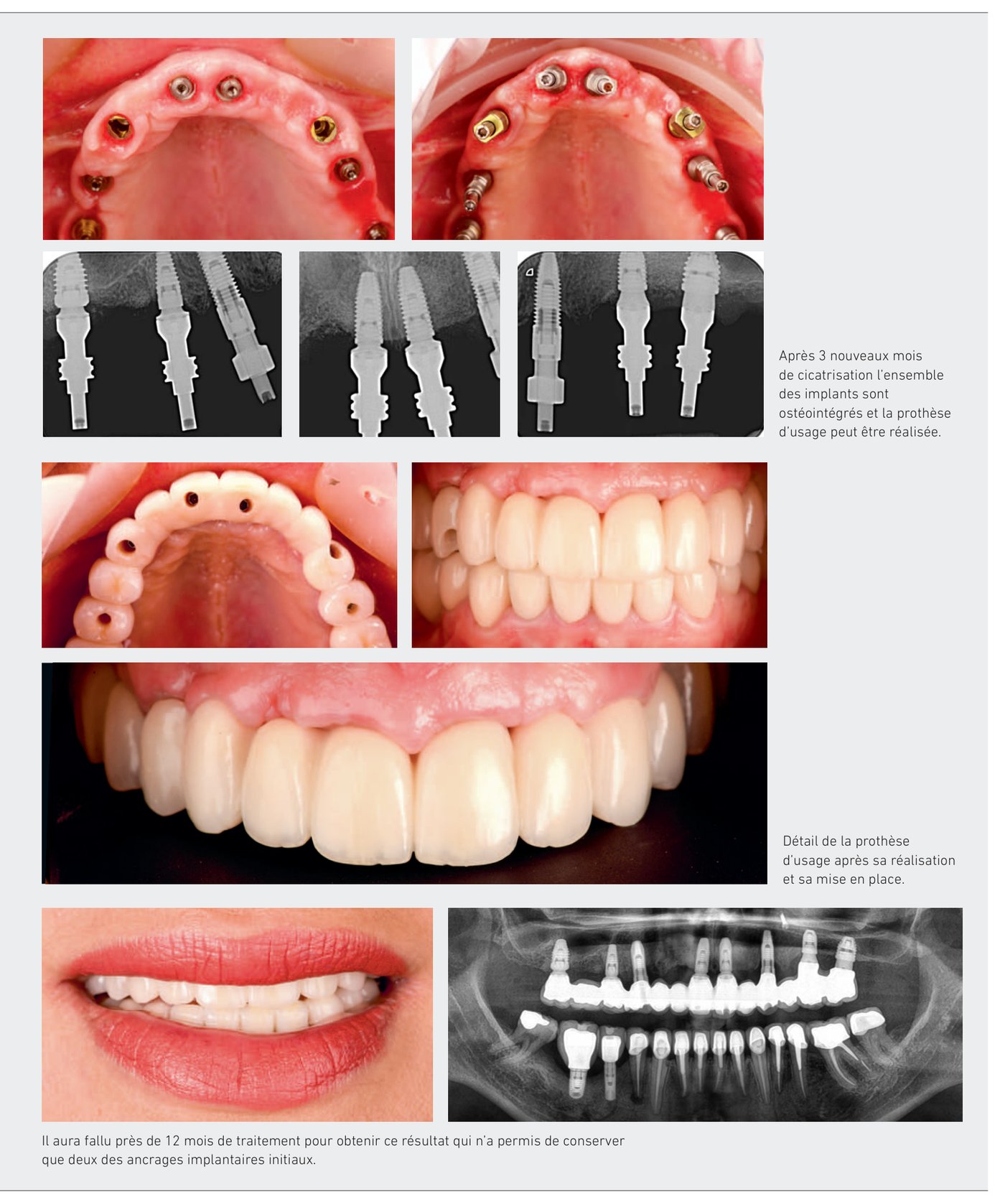 Réhabilitation globale — résultat final