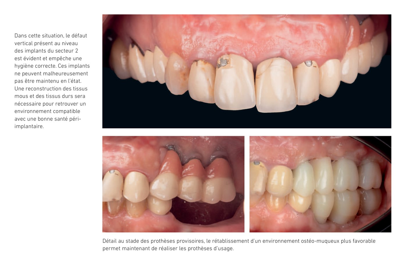 Évaluation des défauts verticaux de positionnement implantaire