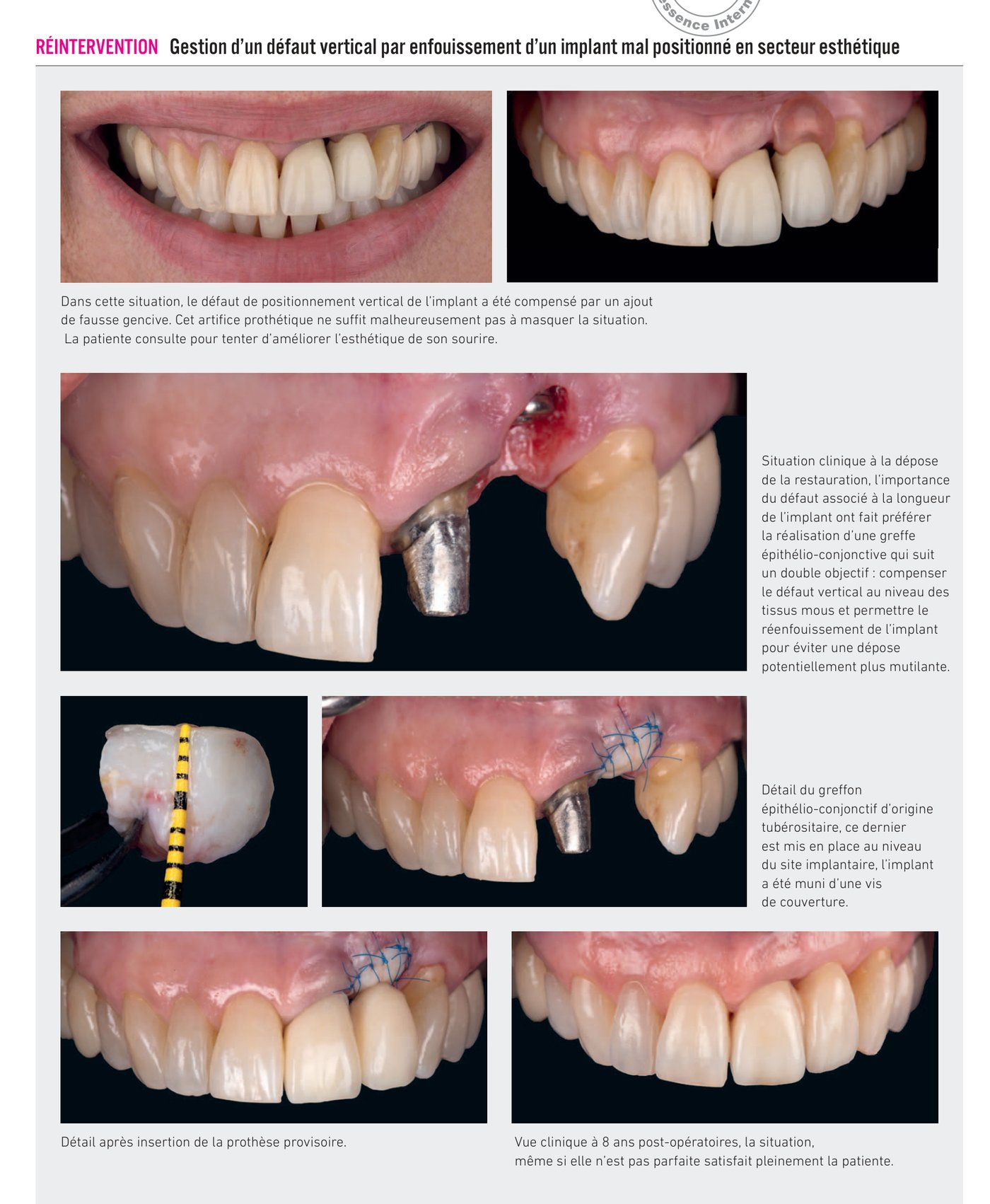 Cas clinique : gestion d'un défaut vertical par enfouissement