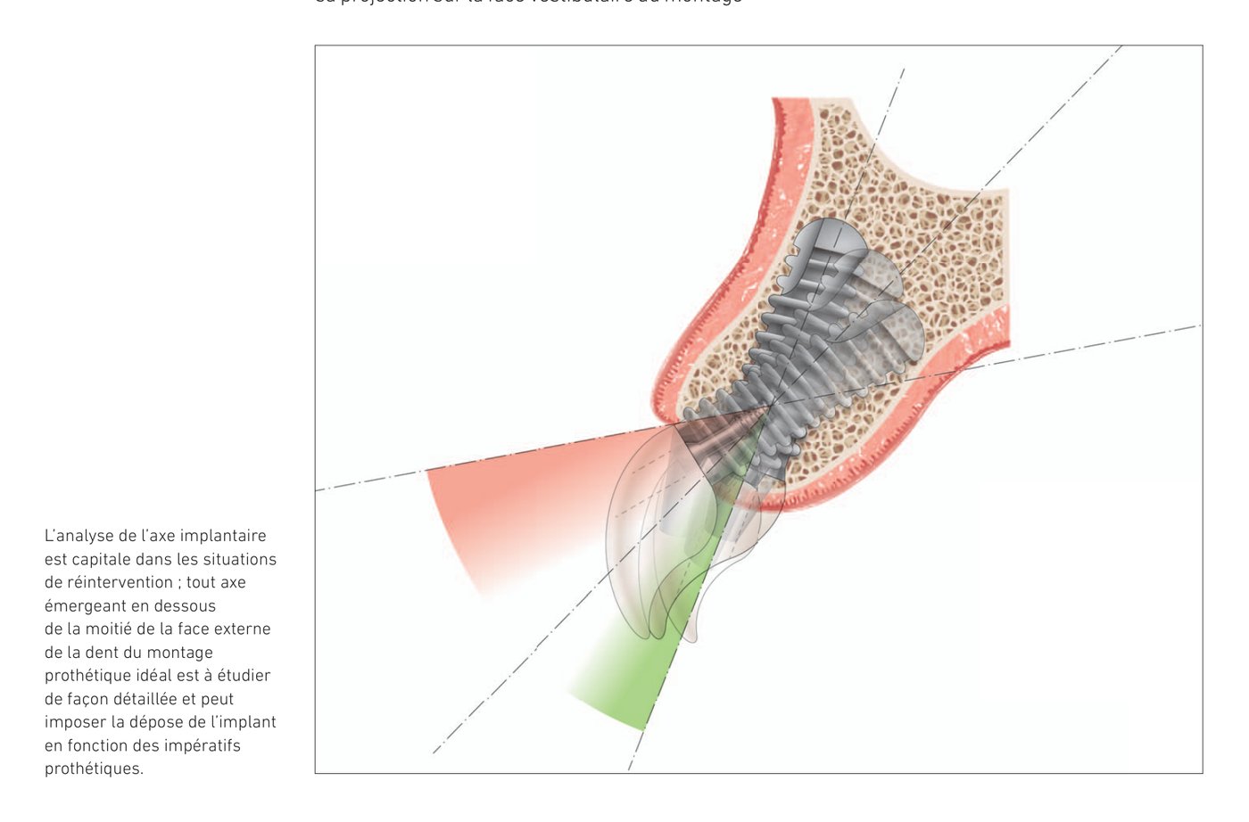 Diagrammes d'évaluation de l'axe implantaire et indications de dépose