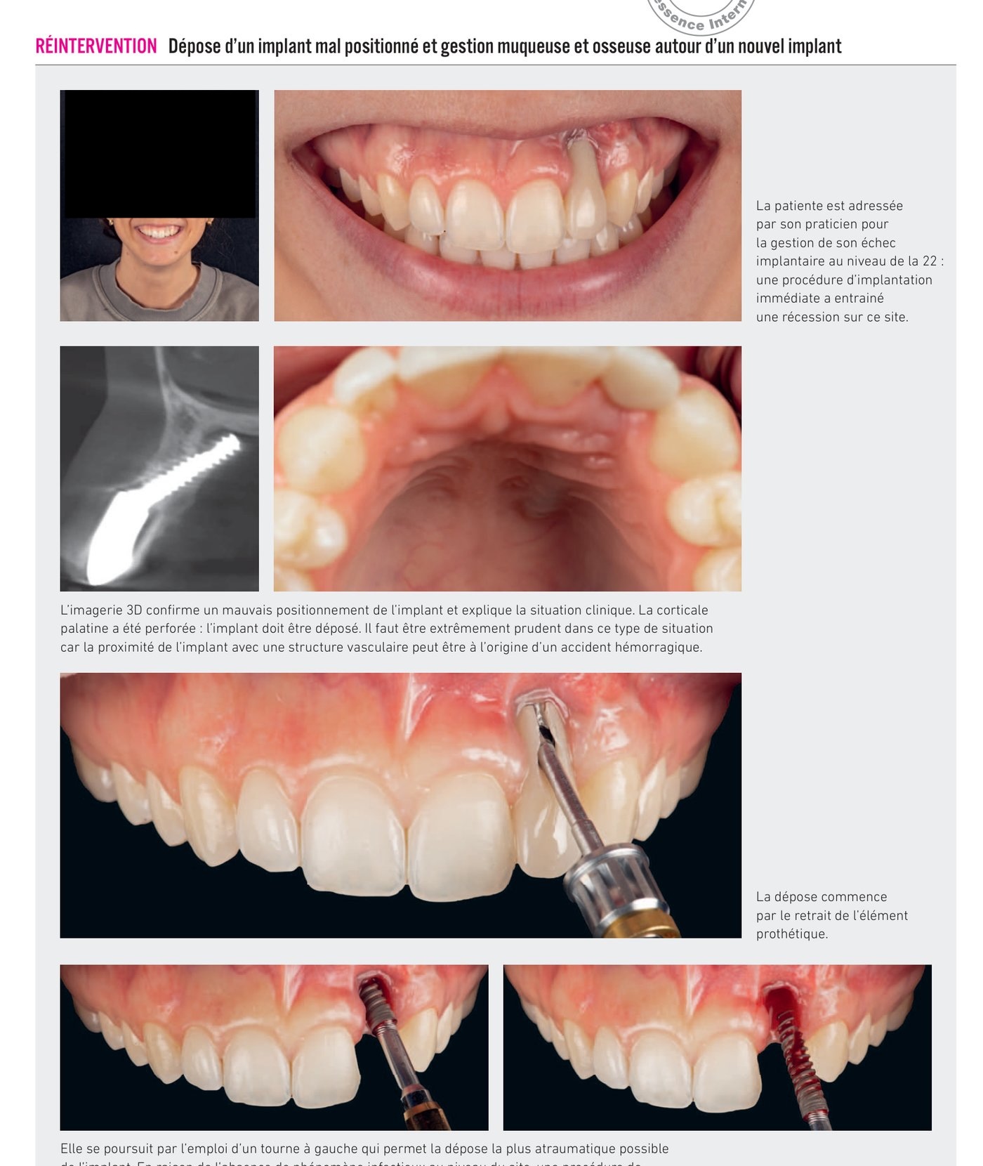 Dépose d'un implant mal positionné — situation initiale et planification