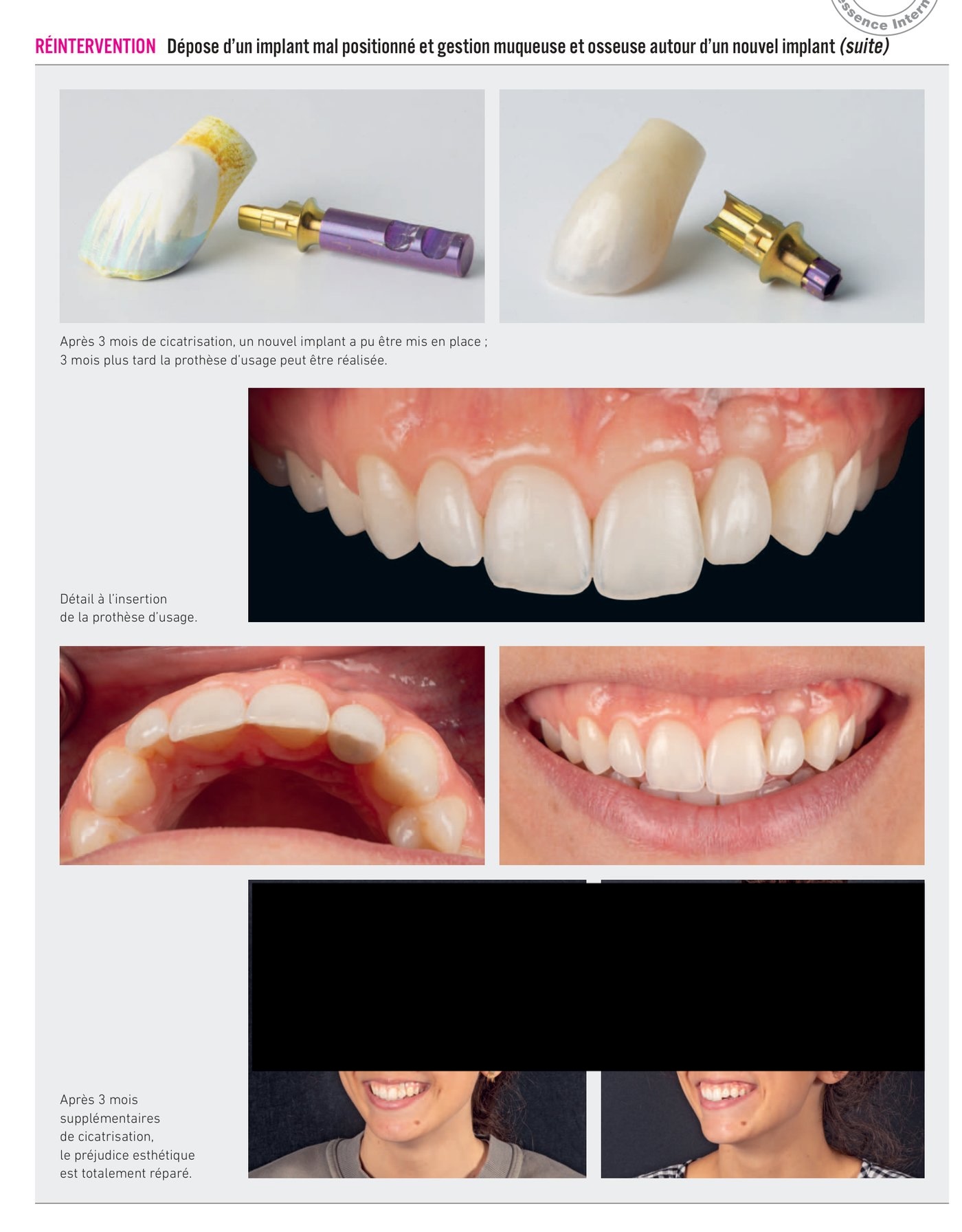 Dépose d'un implant mal positionné — gestion osseuse et muqueuse