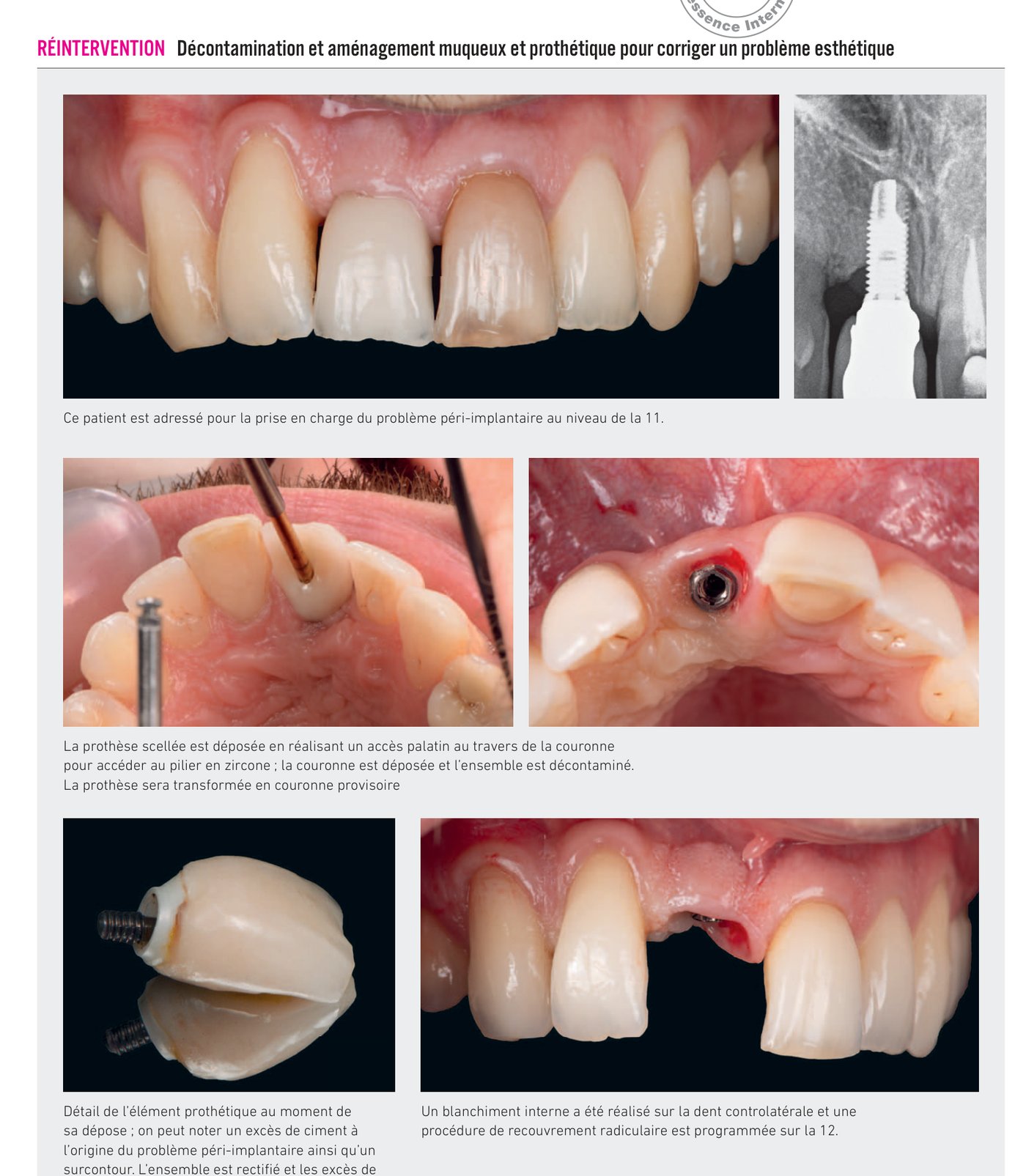 Décontamination et aménagement muqueux — situation initiale et traitement