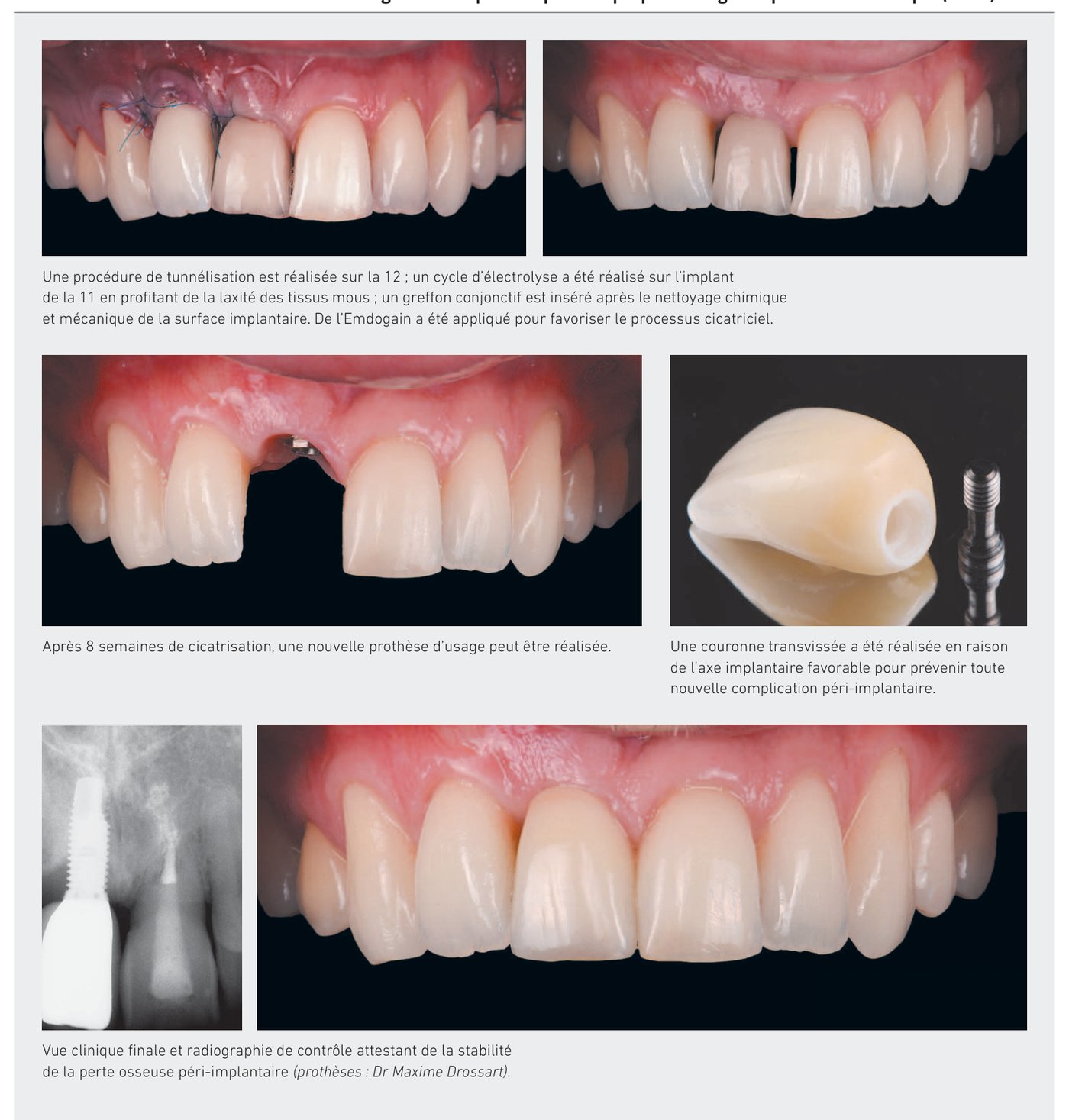 Décontamination et aménagement muqueux — résultat