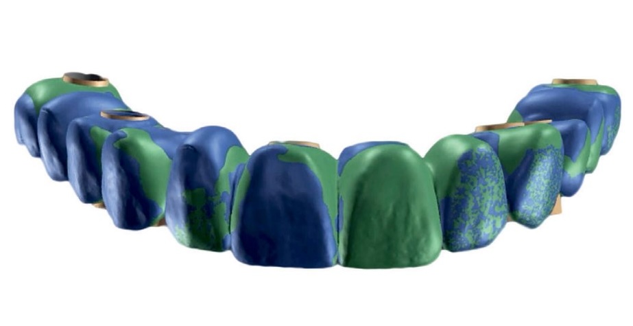 Le procédé Speed Sync Provisional — présentation du cas clinique initial et planification prothétique