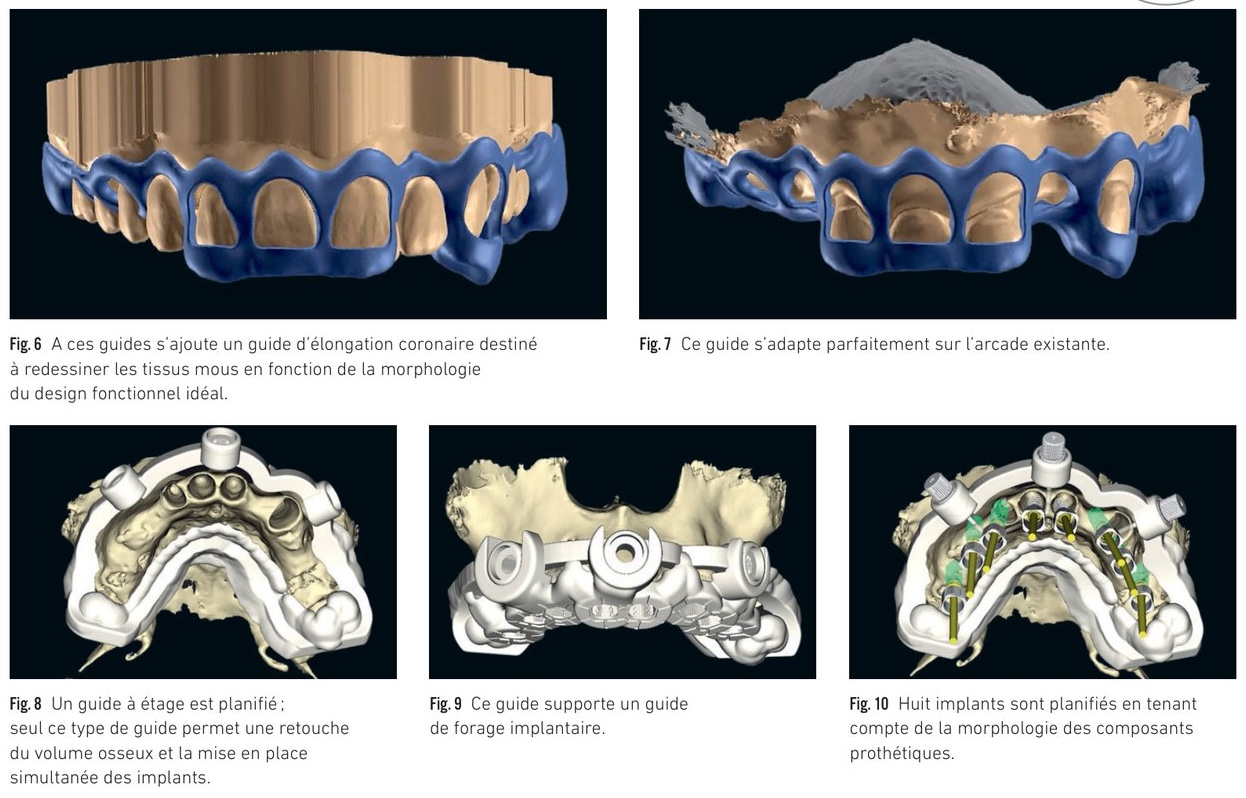 Guides chirurgicaux séquentiels et planification implantaire avancée