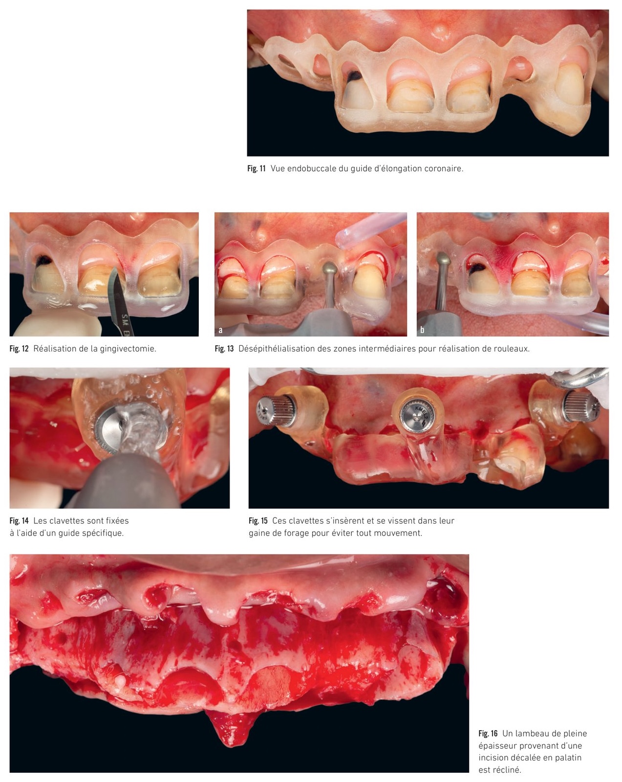 Déroulement chirurgical — stabilisation initiale, extractions et gestion des tissus mous