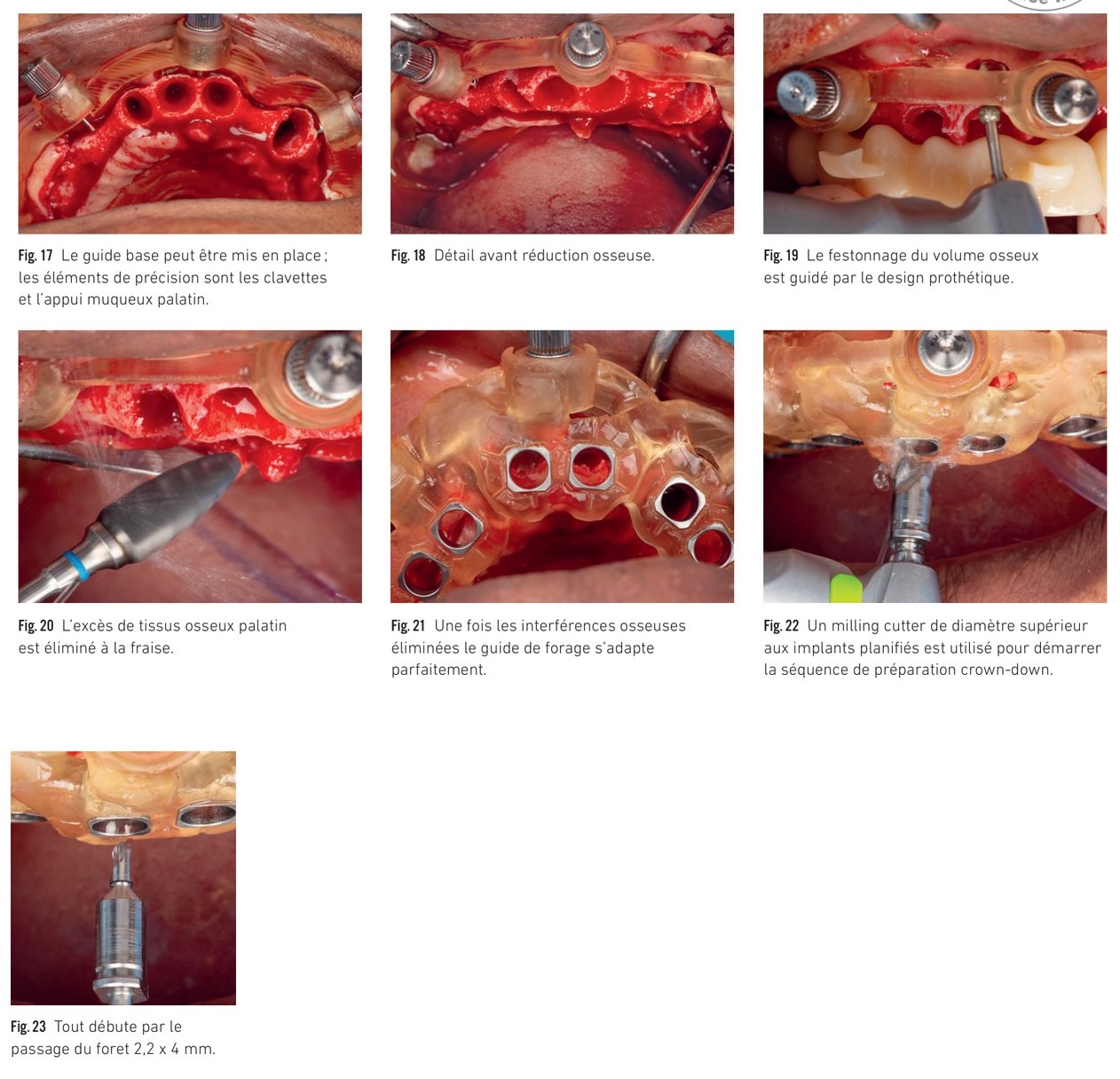 Ostéotomie guidée, festonnage homothétique et technique de préparation implantaire crown-down