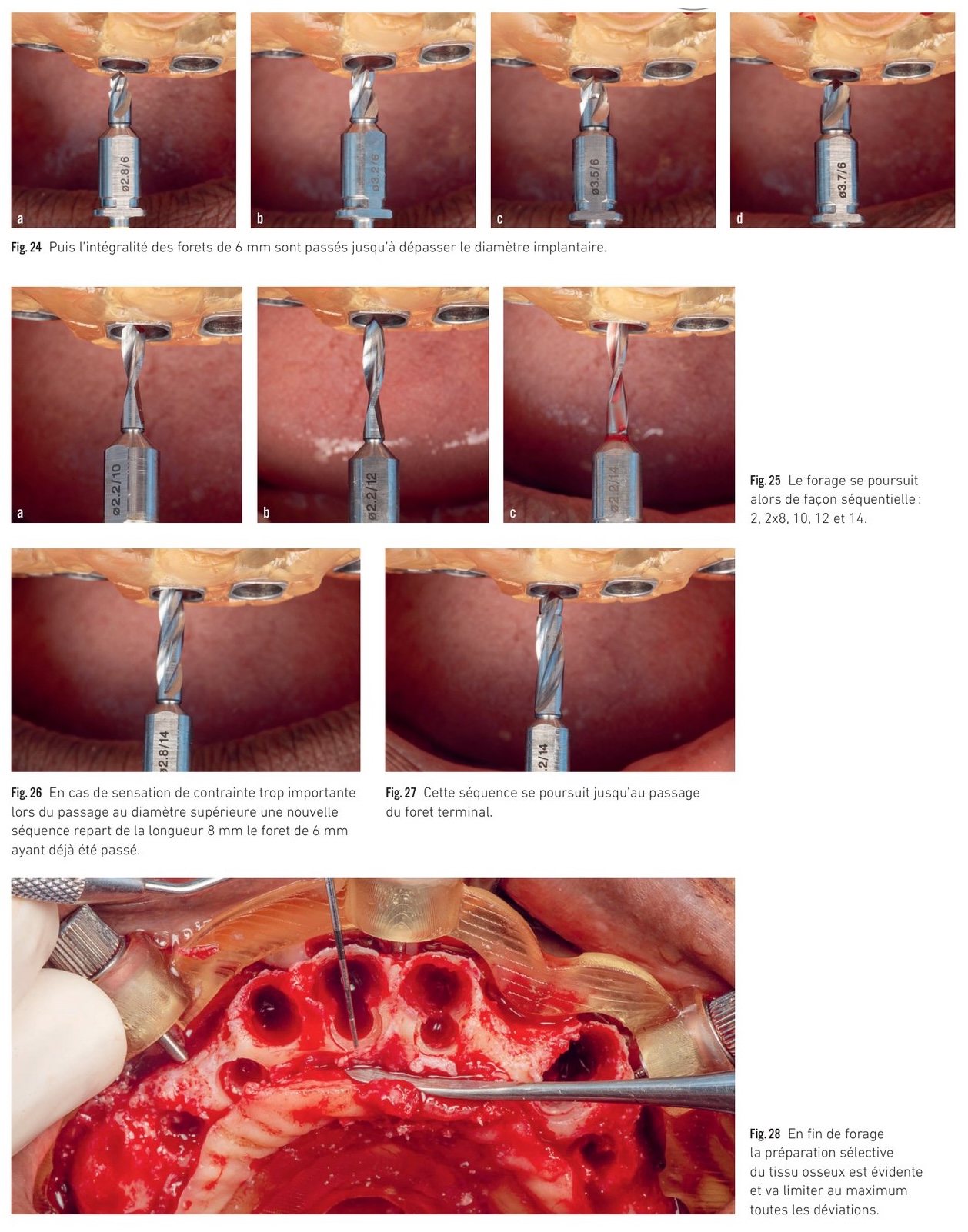 Séquence de forage — préparation sélective du tissu osseux et forets de différents diamètres