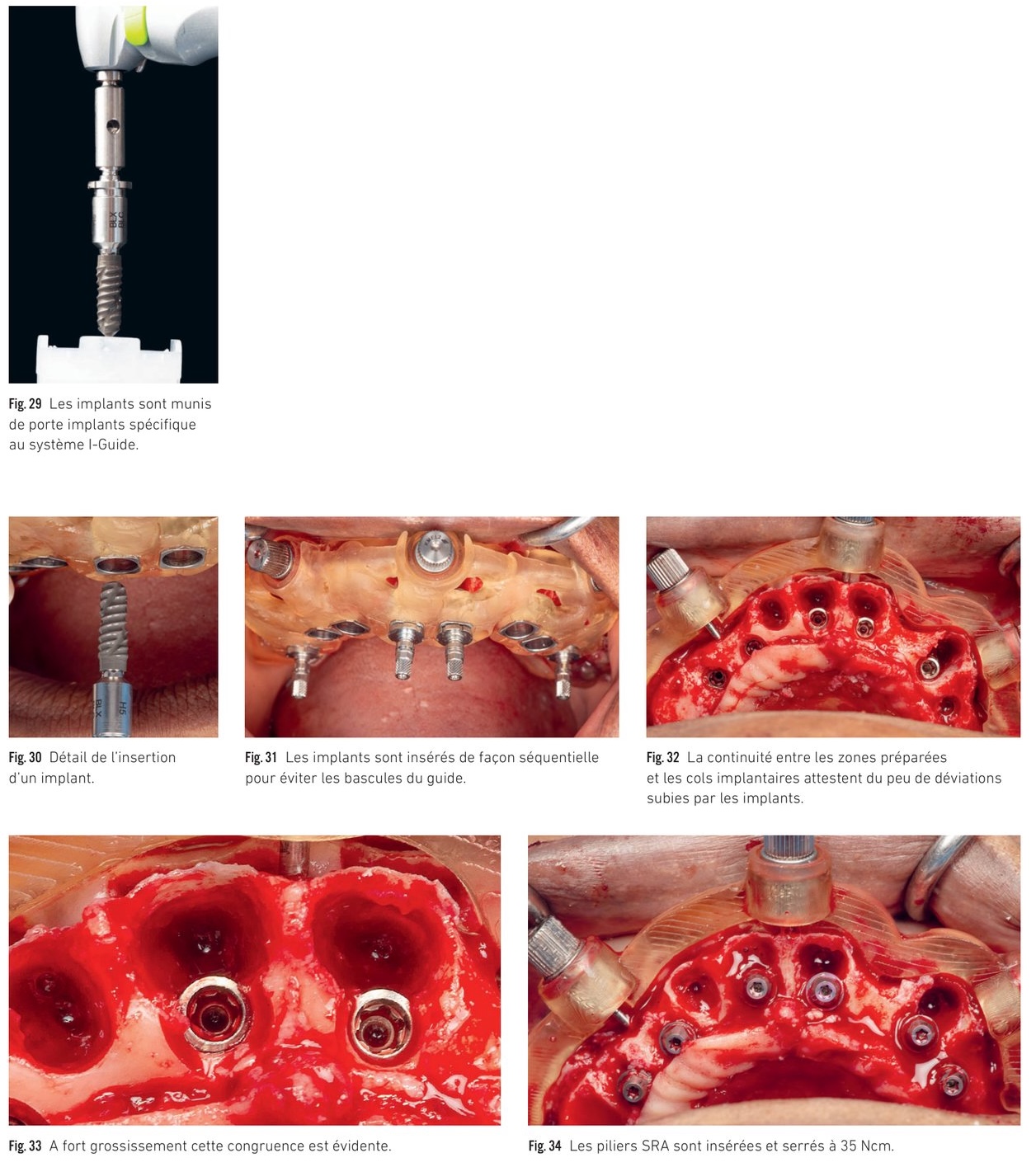 Mise en place des implants, application du protocole SSP et acquisition photogrammétrique