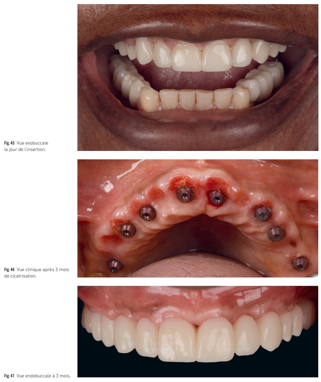 Résultat clinique — mise en charge immédiate et suivi à 3 mois